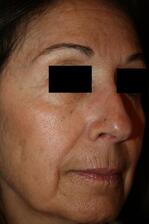 C02 Before Treatment