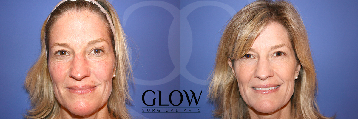Laser treatments before & after San Francisco