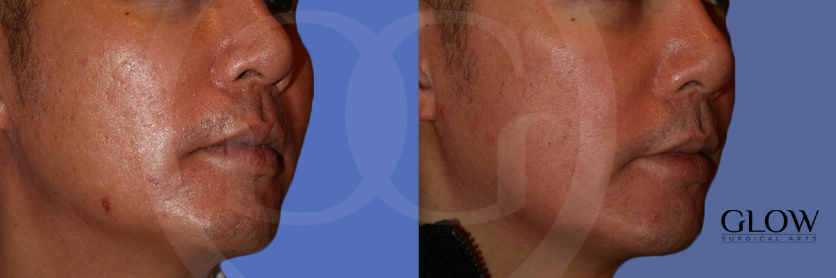 Laser treatments photos Redwood City