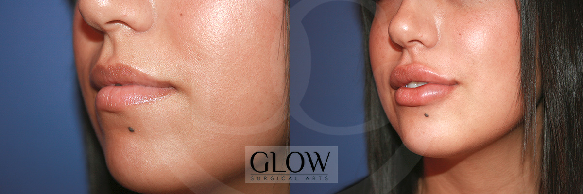 Botox before & after images West Bay Area