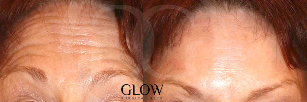 Botox before & after images Redwood City