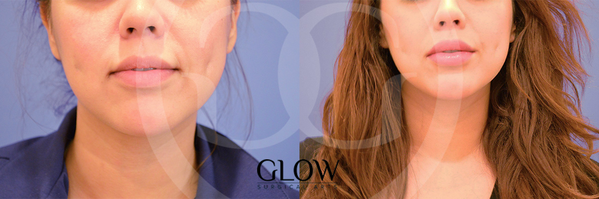 Botox & Dermal Fillers photos West Bay Area
