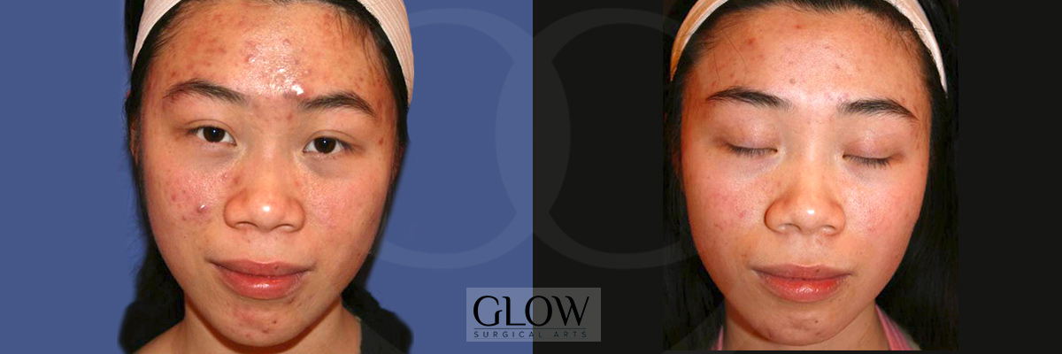 Laser treatments images Redwood City