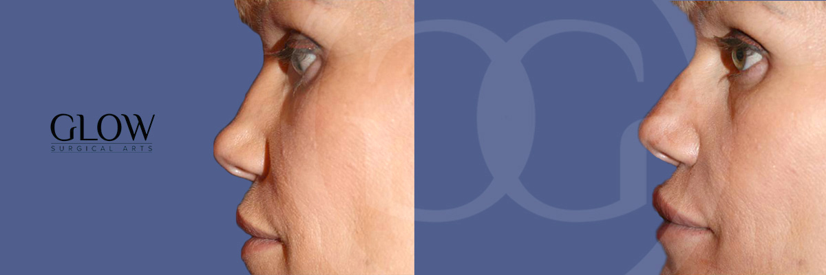 Botox before & after images San Francisco