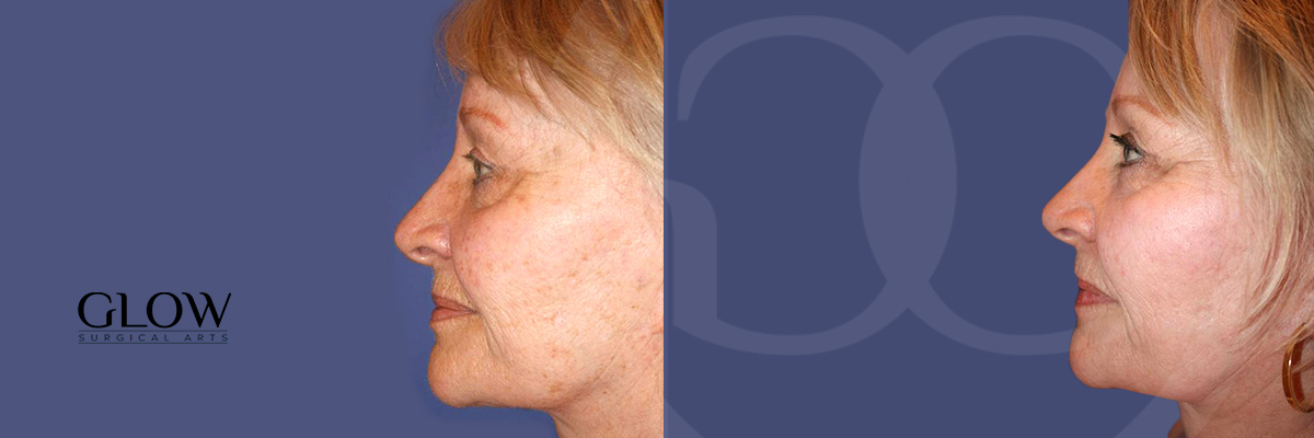 Laser treatments photos West Bay Area