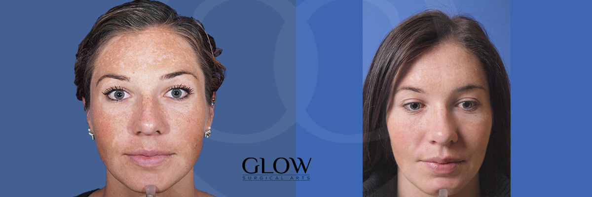 Laser treatments before & after West Bay Area