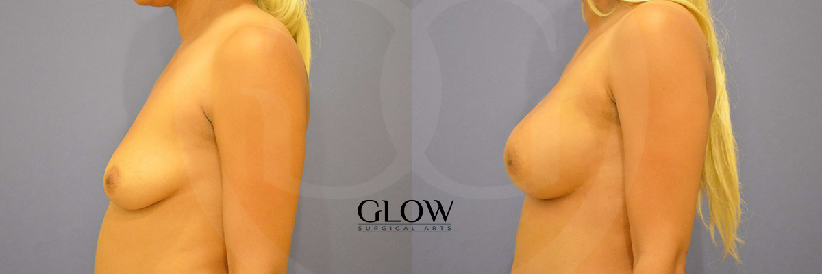 Breast fat transfer before & after Northern California
