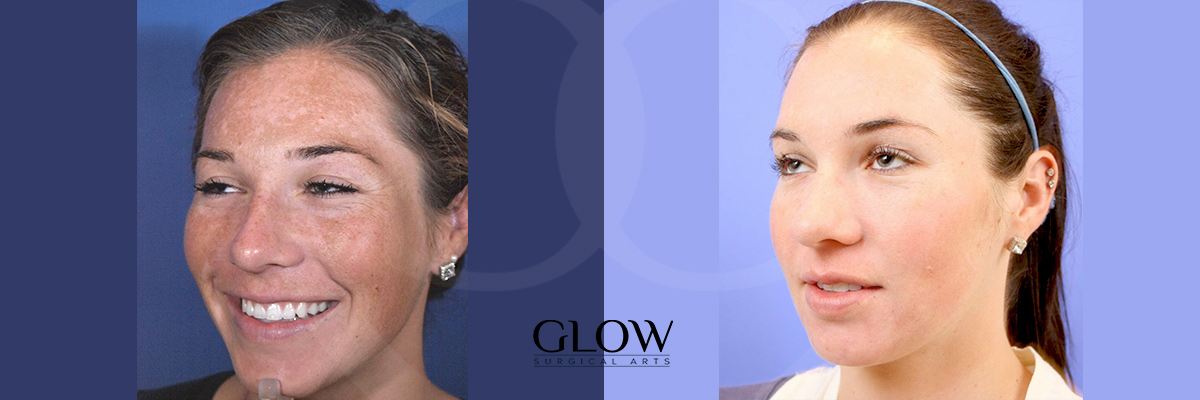 Laser treatments before & after Redwood City