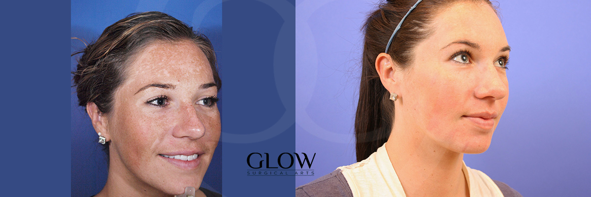 Laser treatments images San Francisco