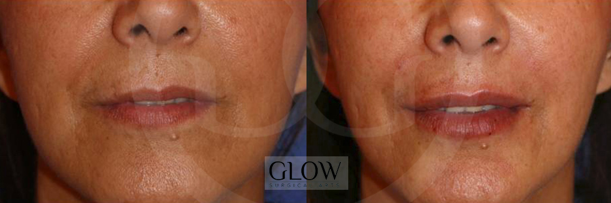Dermal fillers before & after Redwood City