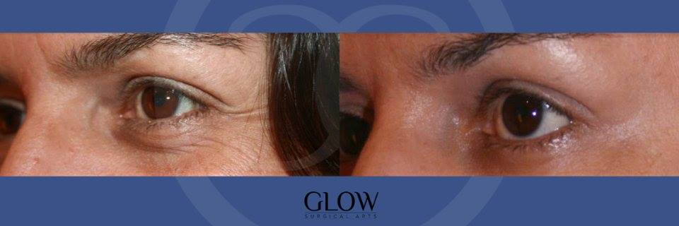 Dermal Fillers before & after images San Francisco