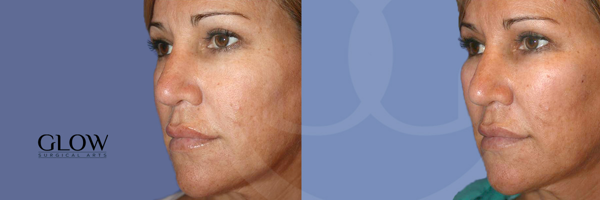 Dermal fillers before & after West Bay Area