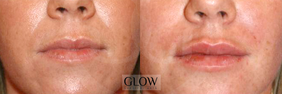 Botox & Dermal Fillers photos Northern California