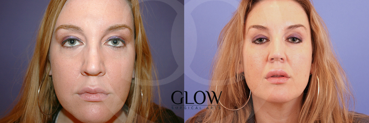 Botox & Dermal Fillers photos Redwood City