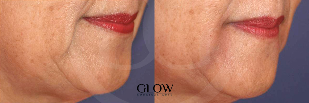 Botox & Dermal Fillers photos San Francisco