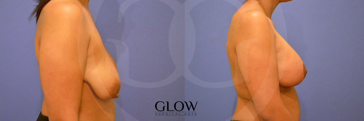 Breast lift surgery before and after gallery