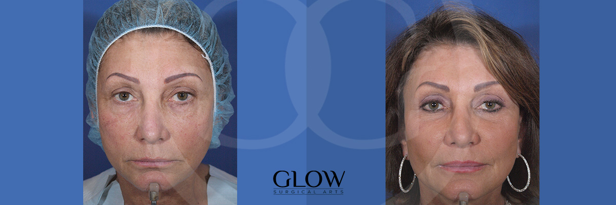 Facial fat transfer before & after San Francisco