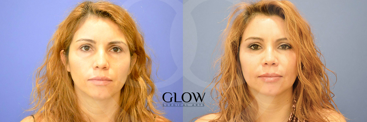 Facial fat transfer images West Bay Area