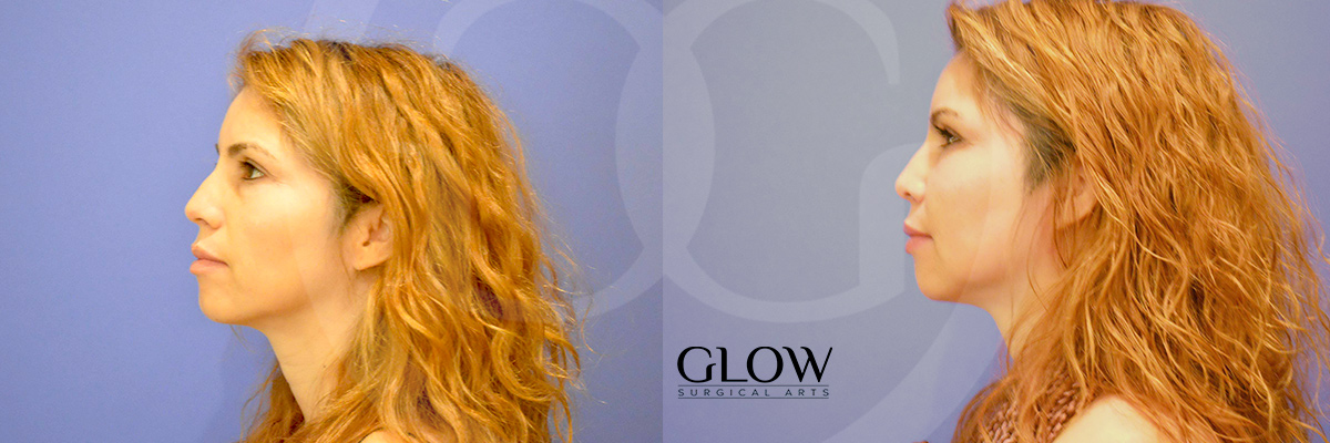 Facial fat transfer before and after photos