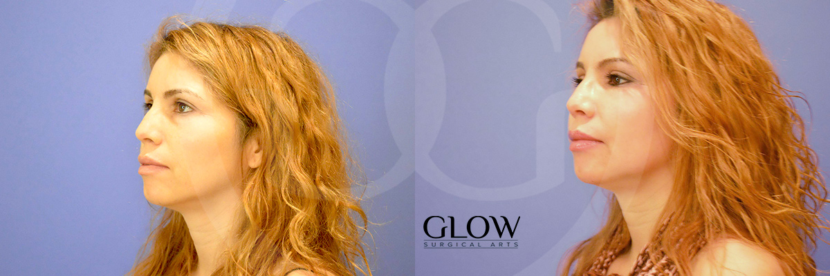 Facial fat transfer images Redwood City