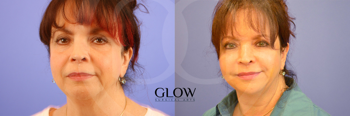 Facial fat transfer before & after Redwood City