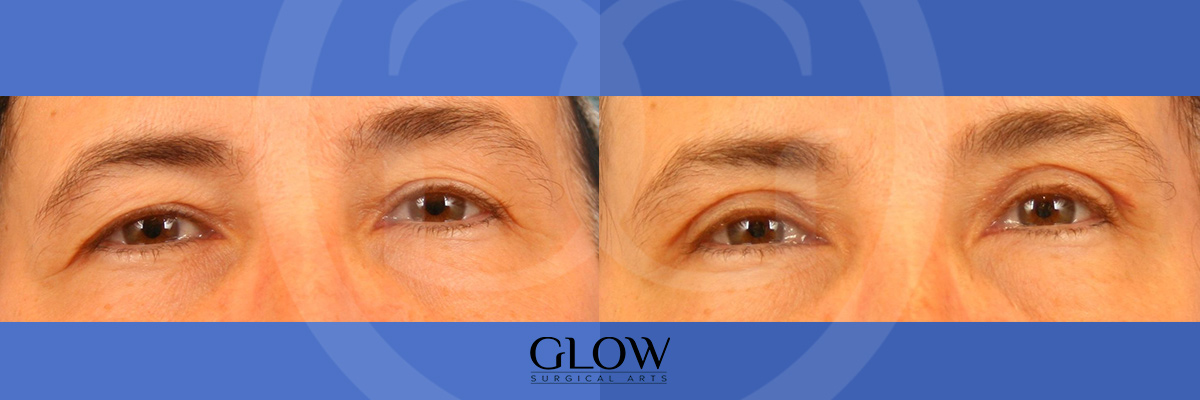 Eye lift before & after West Bay Area