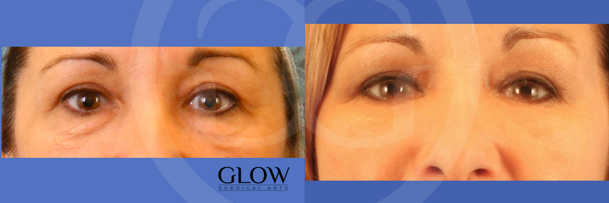 Eye lift before & after Redwood City
