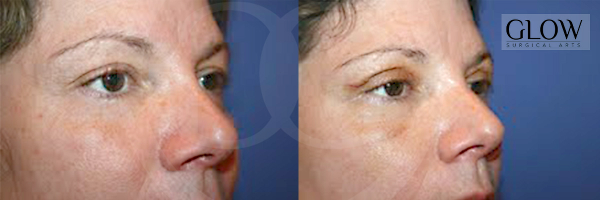 Eye lift photos redwood city
