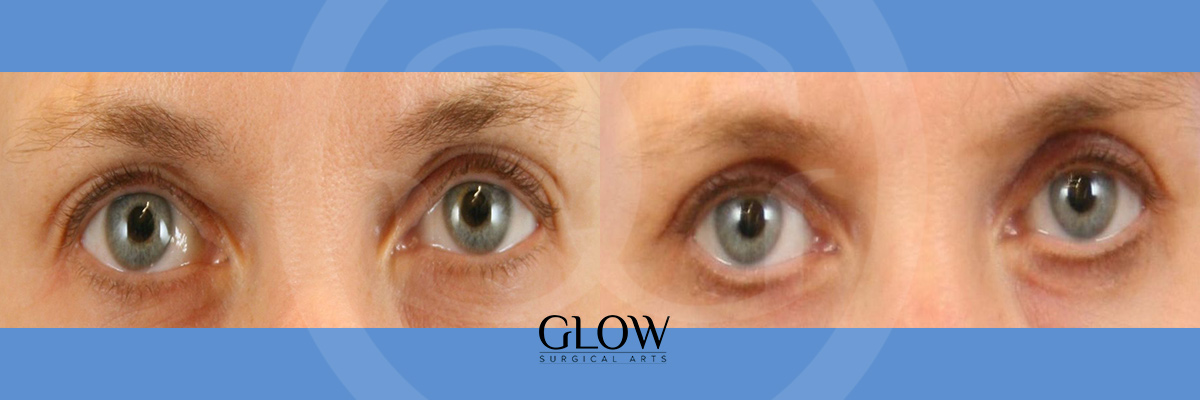 Eye lift photos West bay area