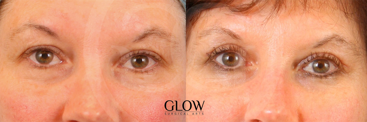 Eye lift before & after San Francisco