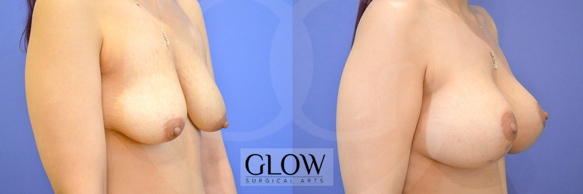 Breast lift before & after West bay area