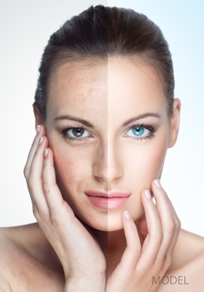 laser_skin_resurfacing