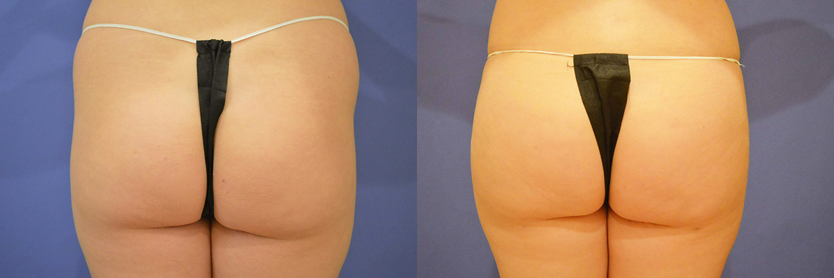 large volume fat transfer to buttocks