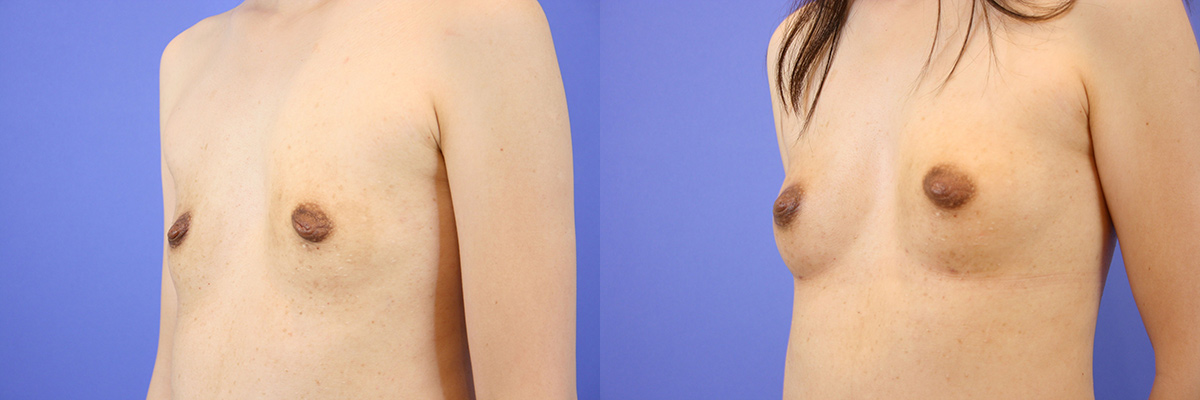 Breast fat transfer before & after West Bay Area