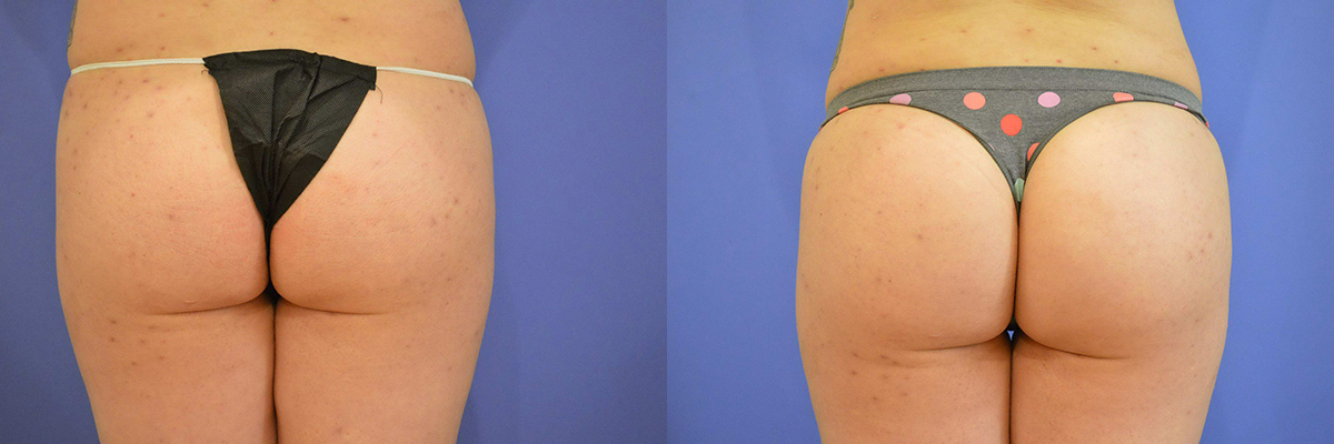 smart lipo of lower back with fat transfer