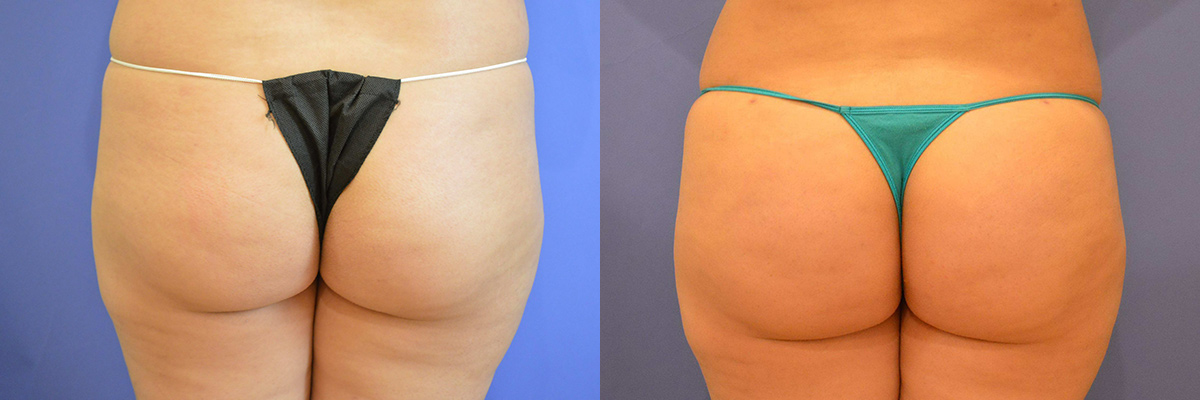 before and after photos liposculpting with fat transfer