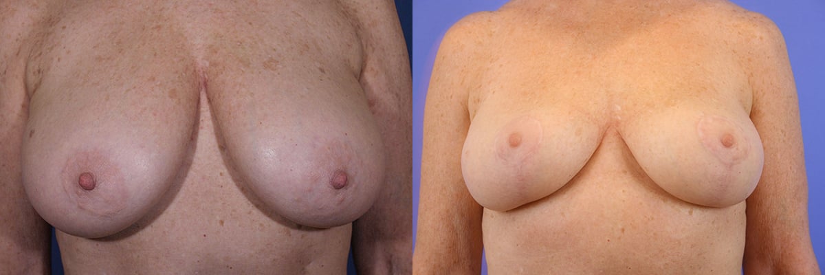 Redwood city breast lift