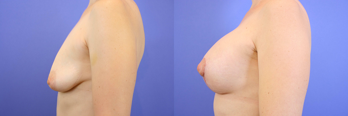 Breast lift in Redwood City
