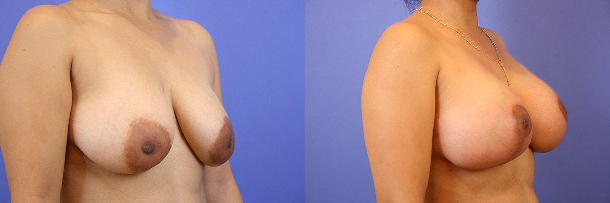 Breast lift images San Francisco