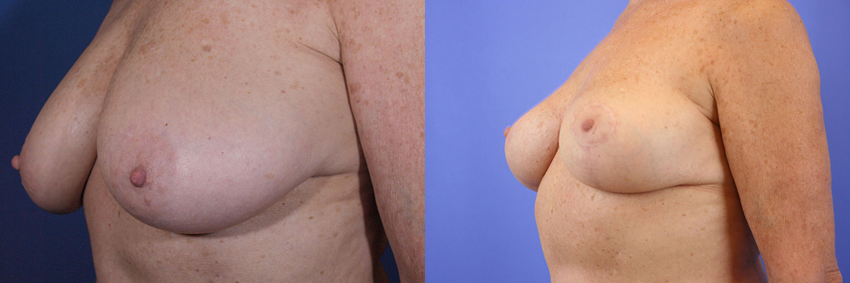 Breast lift surgery gallery San Francisco