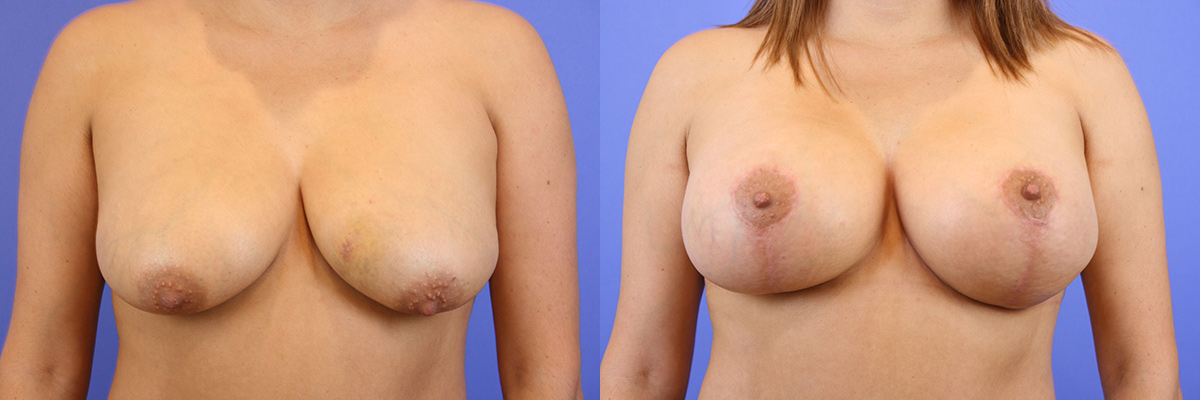 Breast lift images Redwood City