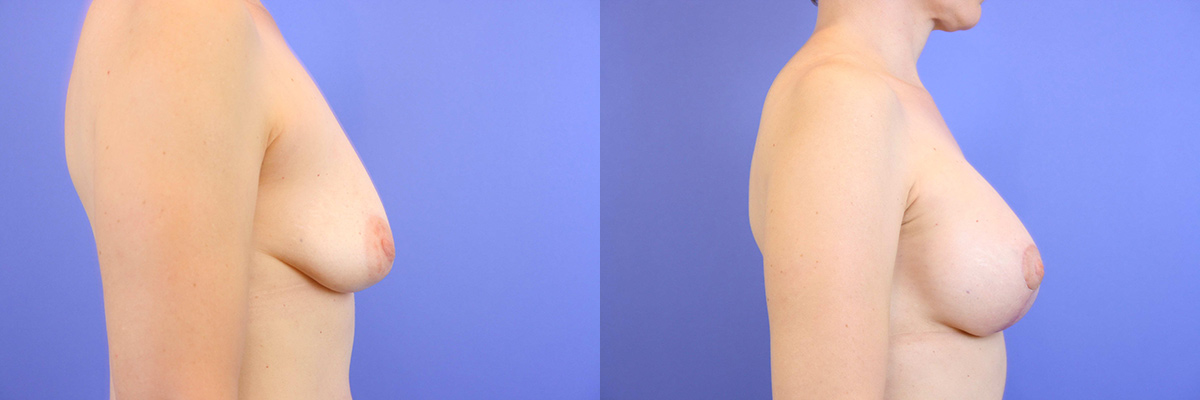 West bay area breast lift