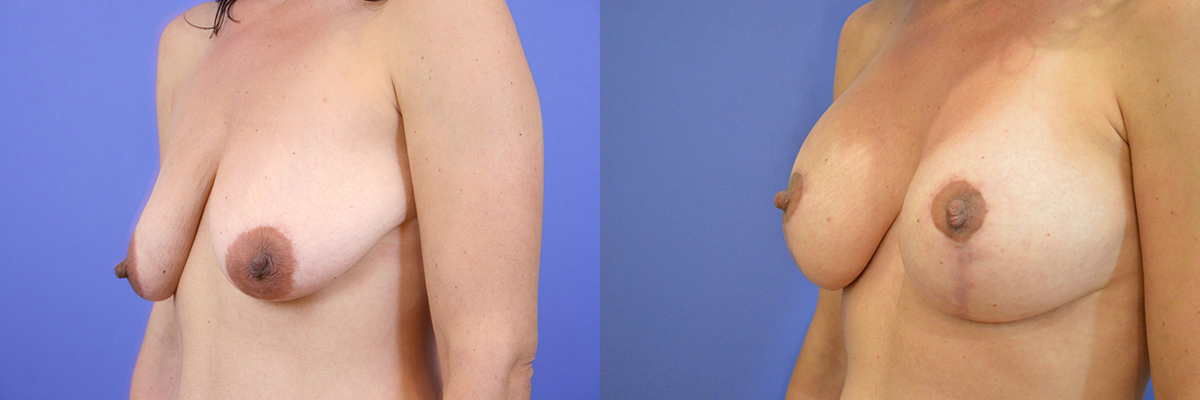 Breast lift in San Francisco