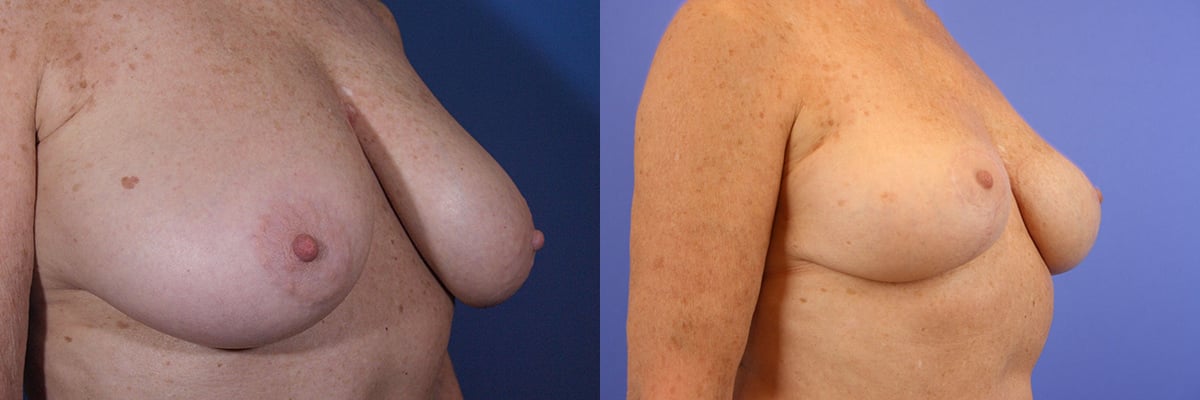 Breast lift surgery gallery West Bay Area