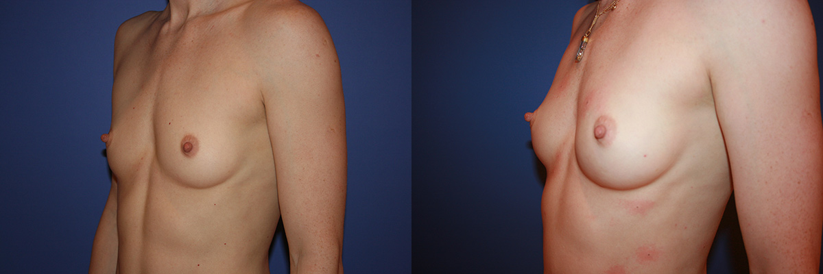 Breast fat transfer before & after Redwood City