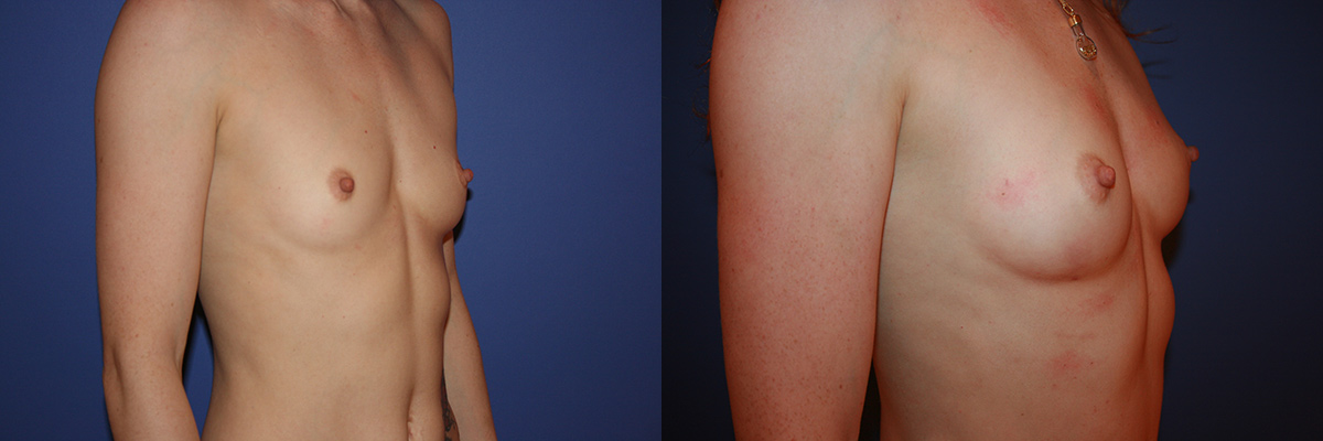 Breast fat transfer before & after San Francisco