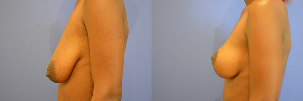 Breast lift surgery gallery Redwood City