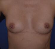 Saline Breast Augmentation