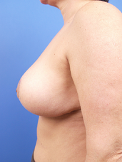 patient after mastopexy