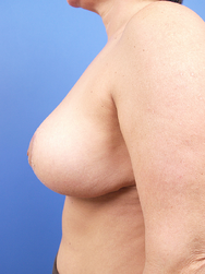 Mastopexy